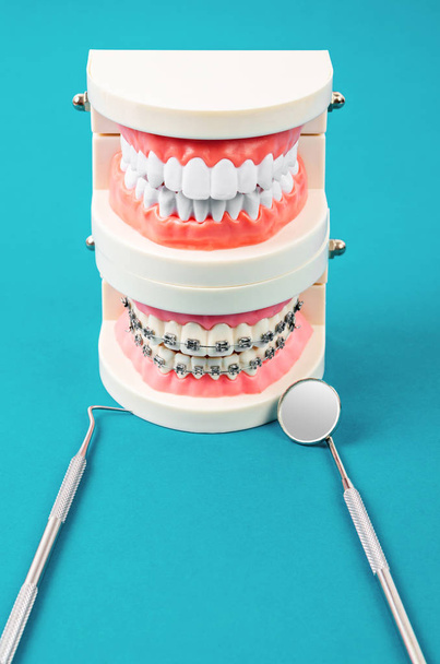 Compare el modelo de dientes y el modelo de dientes con abrazaderas y equipos dentales de alambre metálico sobre fondo azul. - Foto, imagen