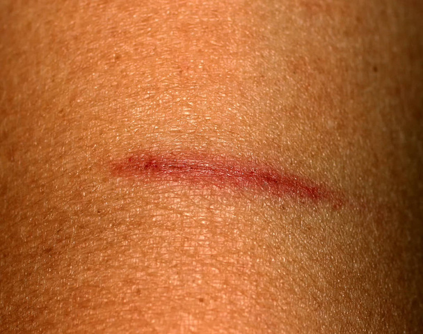 Corte en la piel. Herida, abrasión, arañazos
 - Foto, imagen