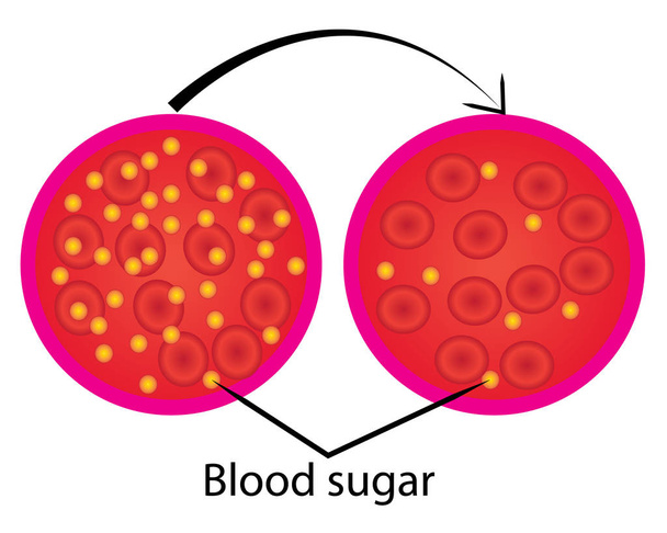 reduzir o controlo dos níveis de açúcar no sangue
  - Vetor, Imagem