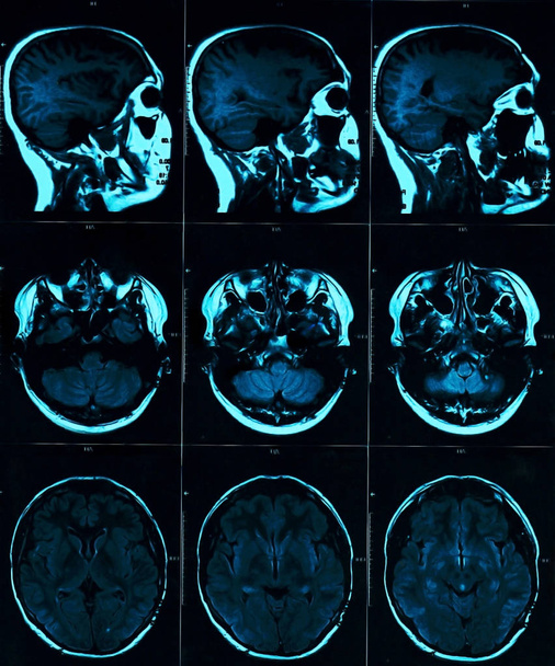 Scansione della risonanza magnetica del cervello con cranio. RM scansione della testa su sfondo scuro colore blu. Medicina a raggi X e concetto di farmaco
 - Foto, immagini