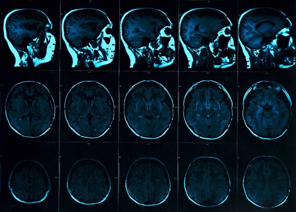 Ressonância magnética do cérebro com crânio. MRI varredura da cabeça no fundo escuro cor azul. Conceito de medicina de raios-X e medicação
 - Foto, Imagem