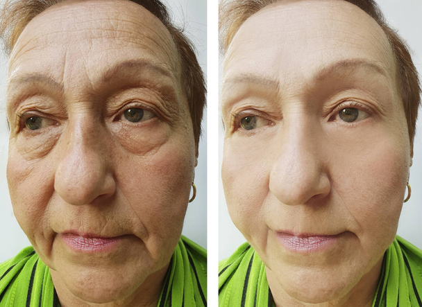 Starší žena tvář před a po zákrocích - Fotografie, Obrázek