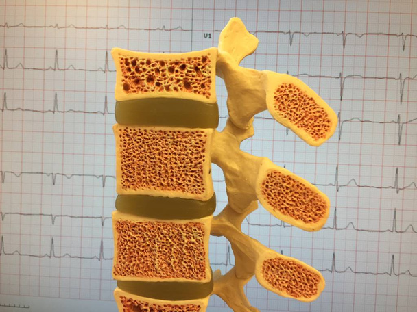 Antiguo modelo anatómico de columna vertebral humana que muestra discos vertebrales, canal espinal y diferentes niveles de osteoporosis
 - Foto, Imagen