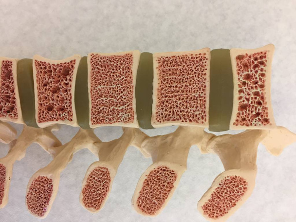 Antiguo modelo anatómico de columna vertebral humana que muestra discos vertebrales, canal espinal y diferentes niveles de osteoporosis
 - Foto, Imagen