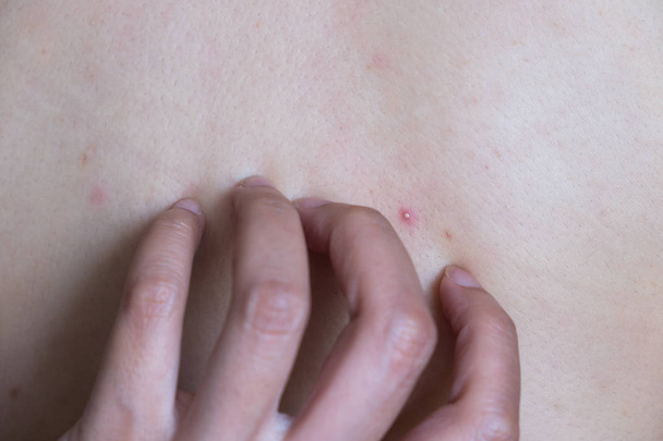 Acne, dermatitis. Acne On The Back. - Photo, Image