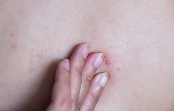 Akne, Dermatitis. Akne auf dem Rücken. - Foto, Bild