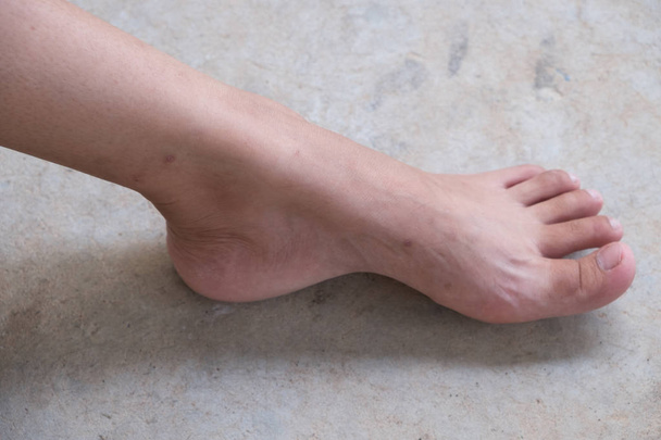 Kucak ayak veya düz taban. Topuklar ve varisli damarlar portre sağlık ve ayak bakımı, kırık. - Fotoğraf, Görsel
