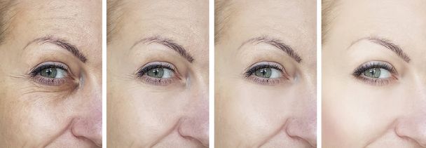 female eye wrinkles before and after treatments - Photo, Image