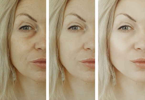 arrugas de la cara de mujer después de tratamientos
 - Foto, Imagen