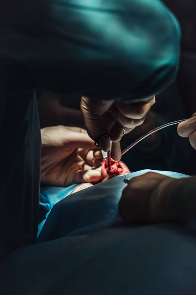 Chirurgie esthétique du nez. Le chirurgien coupe la chair
 - Photo, image