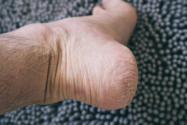 Ξηρό και σκασμένο δέρμα στο τακούνι του άνδρα Καυκάσιος - Φωτογραφία, εικόνα