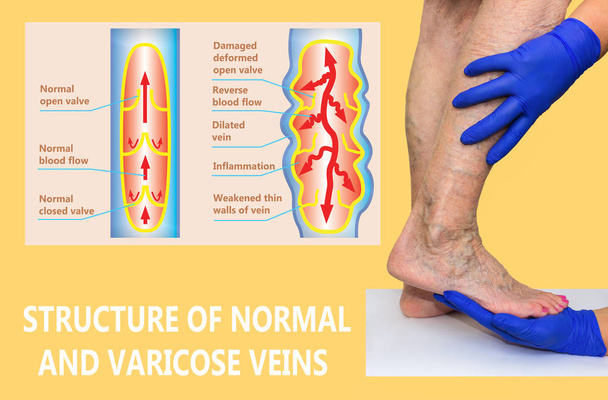 Varicose veins on a female senior legs. The structure of normal and varicose veins. - Photo, Image