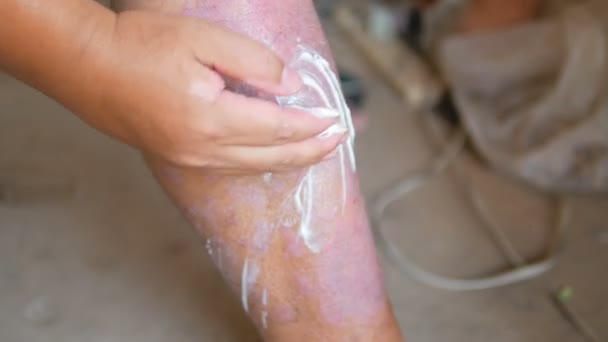 乾癬患者は、傷と自分の足を使用するのに漢方薬を使用します。リンパ節や皮膚病の異常によって引き起こされる病気. - 映像、動画