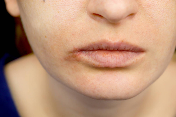 Herpes en los labios: una mujer con un resfriado y el virus del herpes es examinado por un dermatólogo y especialista en enfermedades infecciosas
 - Foto, Imagen