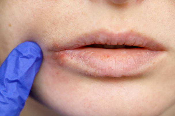 Herpes op de lippen: een vrouw met een koude en het herpesvirus wordt onderzocht door een dermatoloog en besmettelijke ziekte specialist - Foto, afbeelding