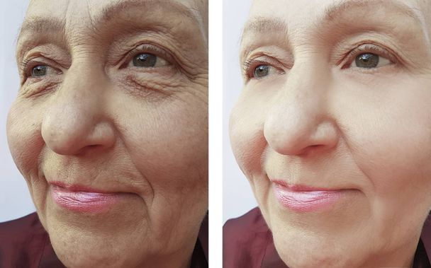 Starsza kobieta zmarszczki twarzy przed i po zabiegach - Zdjęcie, obraz