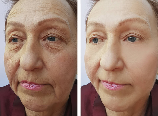 Starsza kobieta zmarszczki twarzy przed i po zabiegach - Zdjęcie, obraz