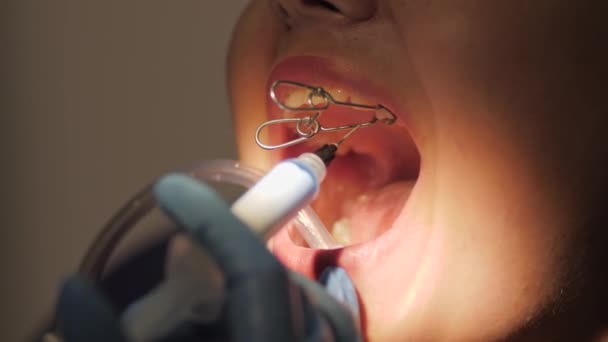 Dentist doing a dental treatment on a female patient. - Séquence, vidéo