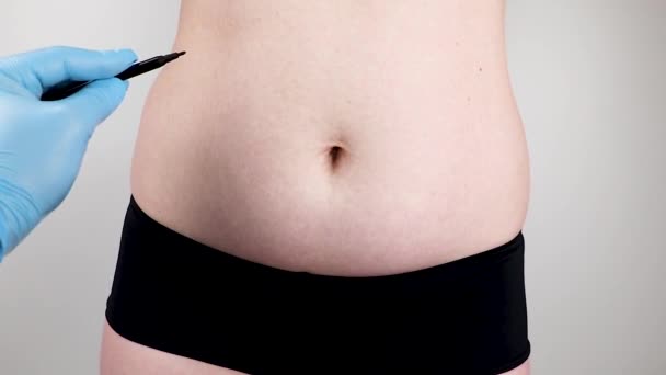 Abdominoplastika a torsoplasty: břicha liposukci a odstranění zástěra. Pacient na recepci penzionu plastický chirurg - Záběry, video