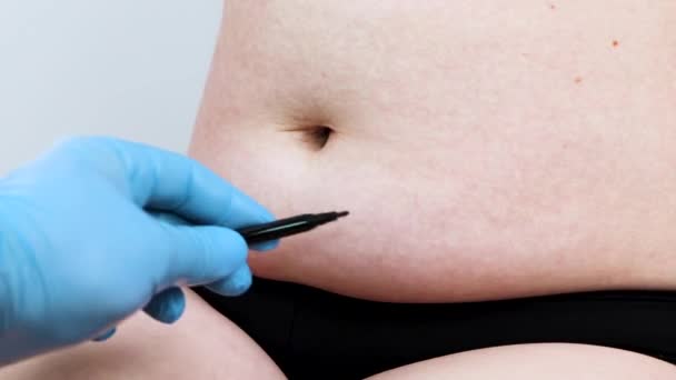 Karın germe ve torsoplasty: karın liposuction ve önlük kaldırılması. Plastik cerrah resepsiyonda hastaya - Video, Çekim