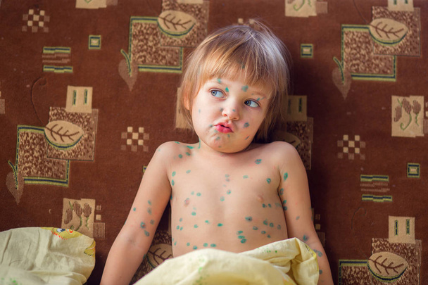 L'enfant qui a la varicelle est assis dans un lit et regarde attentivement de côté. L'enfant pose des tasses
 - Photo, image