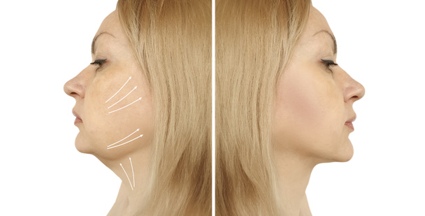 femme double menton avant et après les procédures
 - Photo, image
