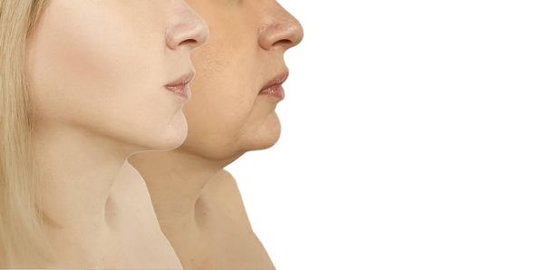 barbilla doble mujer antes y después de los procedimientos
 - Foto, imagen