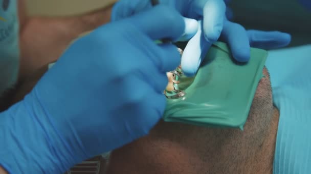 Dentist treating a patient using cofferdam. 4K - Felvétel, videó