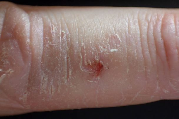 手の皮膚炎。指のアトピー性皮膚炎 - 写真・画像