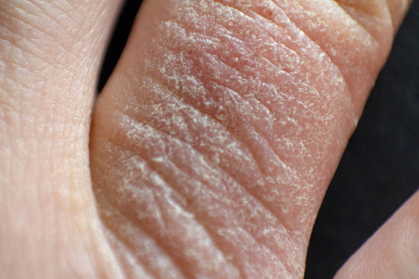 Kézi dermatitis. Ujj ekcéma - Fotó, kép