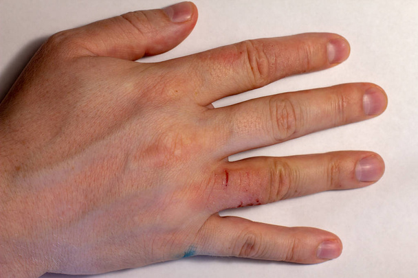 Dermatitis de manos. Eczema del dedo
 - Foto, Imagen