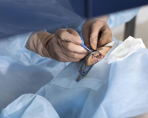 Lazer cerrahisi vizyon düzeltme - Fotoğraf, Görsel