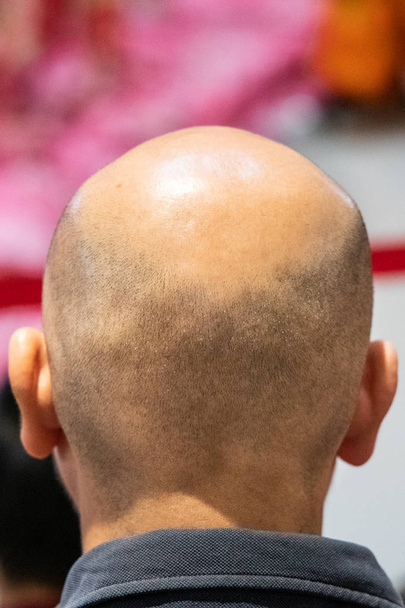 Lähikuva mies ajeltu päänahka kärsivät kaljuuntuva hiustenlähtö
 - Valokuva, kuva