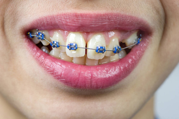 schiefe Zähne und Zahnspangen - Foto, Bild