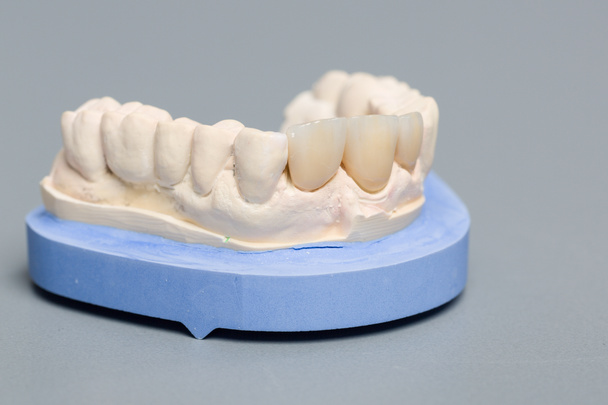 dentition artificielle sur une empreinte dentaire dans un laboratoire dentaire
 - Photo, image