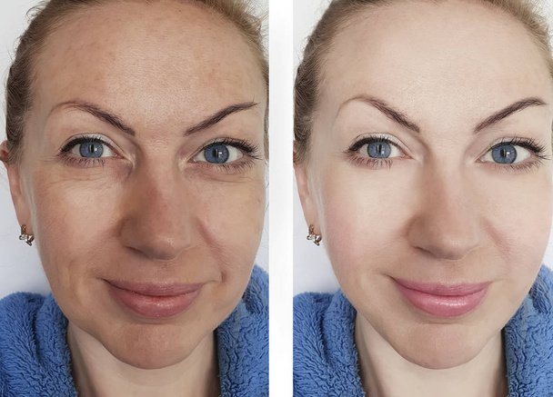 woman wrinkles before and after treatments - Photo, Image