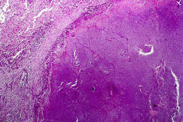 人間の結核の肉芽腫、光学顕微鏡像の乾酪 - 写真・画像