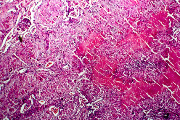 Miliary tuberculose, lichte opname - Foto, afbeelding