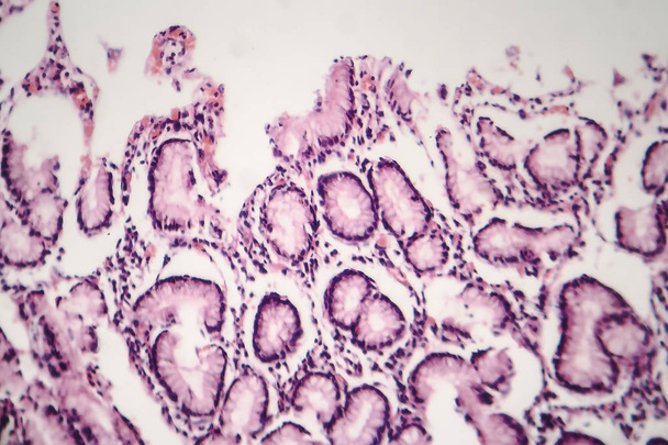 Krooninen atrofinen gastriitti, kevyt mikrografi
 - Valokuva, kuva