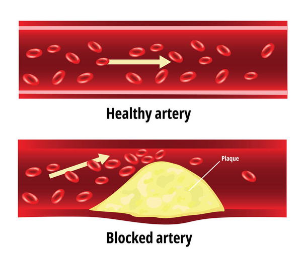 Arteria bloccata, grasso bloccato nell'arteria sanguigna, colesterolo
 - Vettoriali, immagini