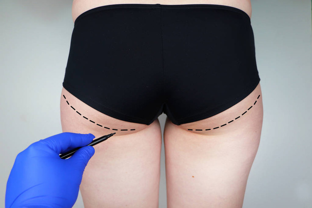Plastic surgery: femoroplasty, cruroplasty, buttocks endoprosthetics, gluteoplasty. Patient on consultation with a plastic surgeon - Foto, afbeelding