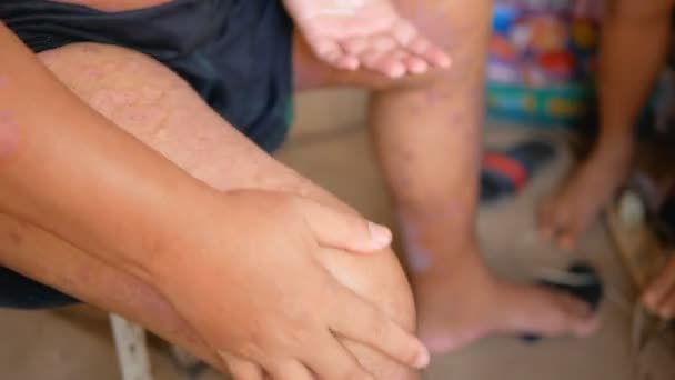 Psoriasis-Patienten verwenden pflanzliche Medikamente, um ihre eigenen Beine mit Wunden zu behandeln. Krankheiten, die durch Anomalien der Lymphe und der Haut verursacht werden. - Filmmaterial, Video