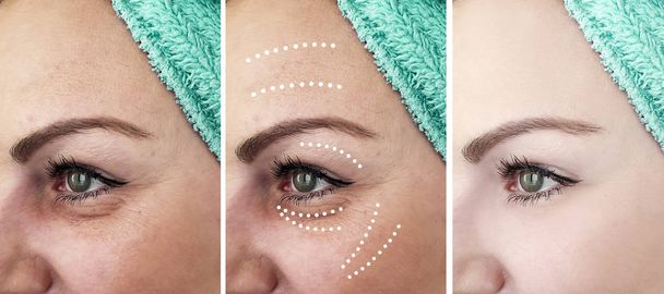 rugas mulher rosto antes e depois de tratamentos
 - Foto, Imagem