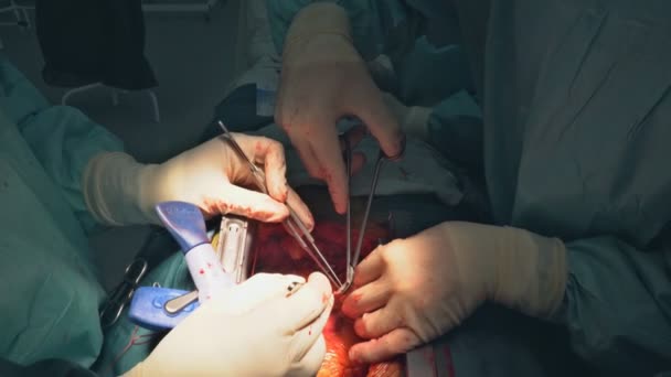 Hartoperatie. Open hart chirurgie hechtdraad groter saphenous ader - Video