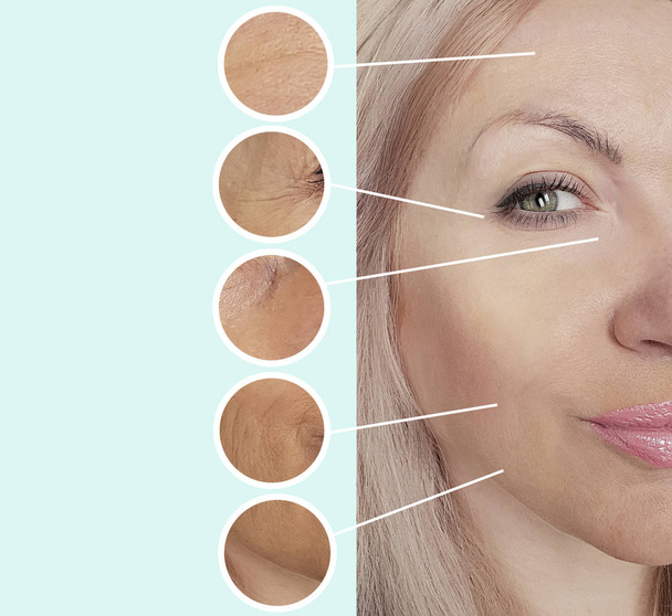 жіночі зморшки обличчя до і після процедур колаж
 - Фото, зображення