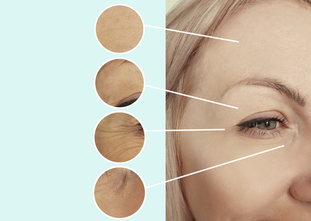 жіночі зморшки обличчя до і після процедур колаж
 - Фото, зображення