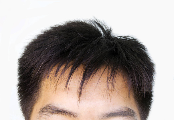 pérdida de cabello, cabeza masculina con síntomas de pérdida de cabello en la parte frontal
 - Foto, Imagen