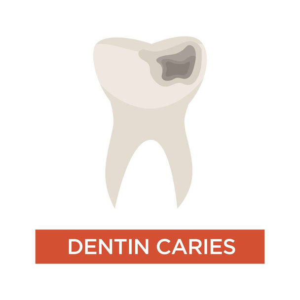 Dentin caries dental care tooth damage hole dentistry - Vector, Image