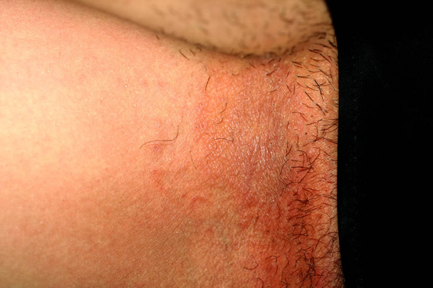 Infección fúngica en la ingle, psoriasis, dermatitis, eczema
. - Foto, Imagen