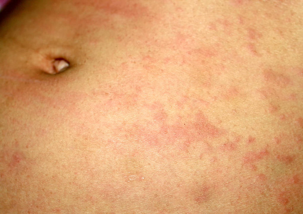 Ροζ λειχήνες στο δέρμα της κοιλιάς. Ψωρίαση, δερματίτιδα, έκζεμα, κνίδωση, αλλεργίες. - Φωτογραφία, εικόνα